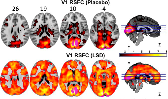 LSD Scans Reveal the Brain’s Secret Portal to Cosmic Consciousness 5 pnas.1518377113fig02